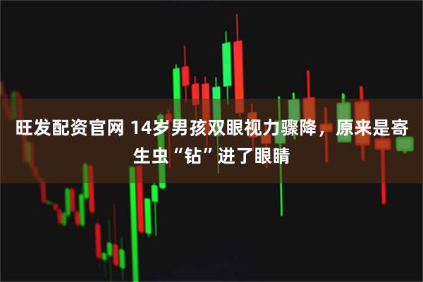 旺发配资官网 14岁男孩双眼视力骤降，原来是寄生虫“钻”进了眼睛